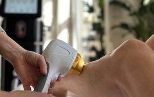 Épilation définitive laser